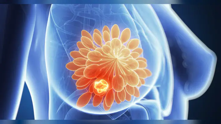 AI company scores world’s 1st approval for breast triage tool that skips radiologist review