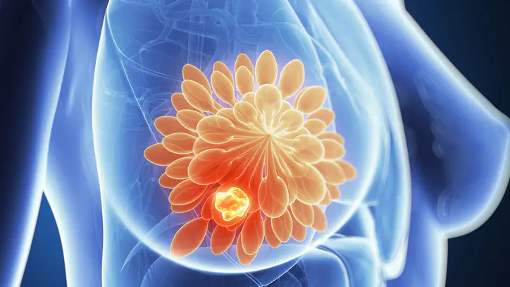 AI company scores world’s 1st approval for breast triage tool that skips radiologist review