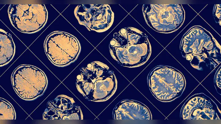 Alzheimer tanısında kan testi dönemi! - Haberler