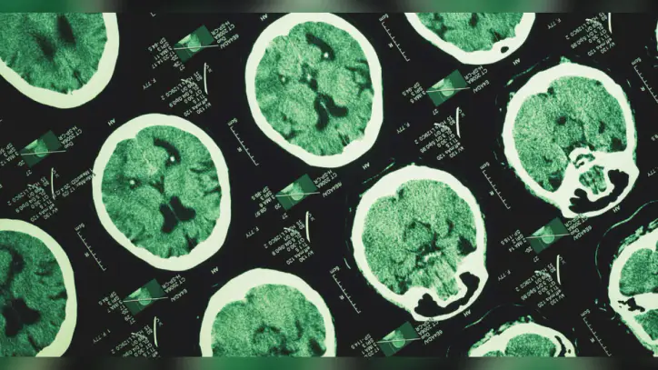 Alzheimer unutkanlıkla başlamıyor! İşte yıllar önce başlayan izler - Haberler