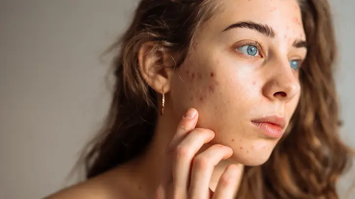 Ergenlerde "cam gibi cilt" takıntısı büyüyor! Uzmanlar uyardı: Serum ve asit yığmak cildi bozuyor, 3 ürün yeterli