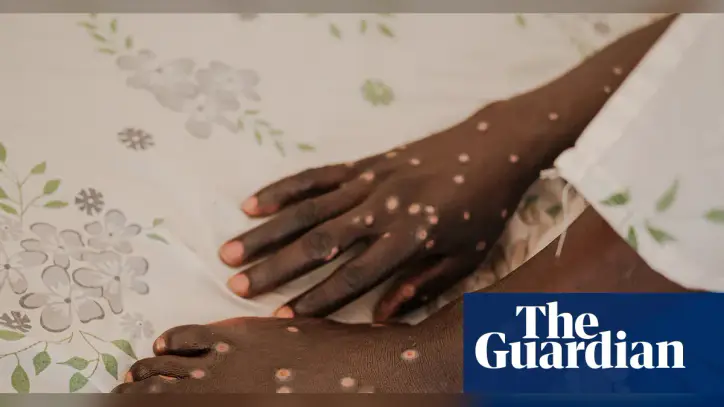 Mpox is back – and in new countries. How can this outbreak be contained?