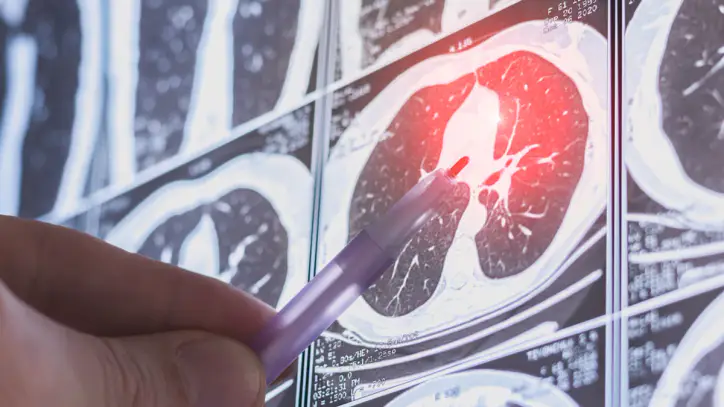 AI model can uncover unseen health issues in CT scans