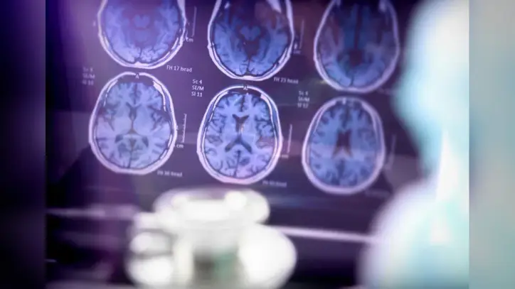 Sinsi hastalık, ilk belirtiden 20 yıl önce başlıyor! Bu hatalar Alzheimer’a zemin hazırlıyor