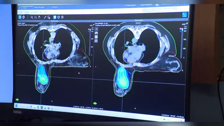 New technique uses artificial intelligence to fight breast cancer