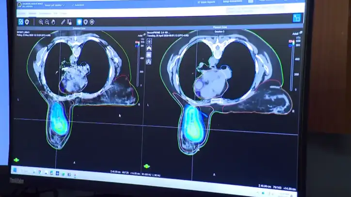 New technique uses artificial intelligence to fight breast cancer
